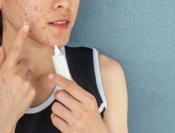 Atasi Jerawat, Kenali Apa Itu Acne Spot Treatment Dan Cara Kerjanya